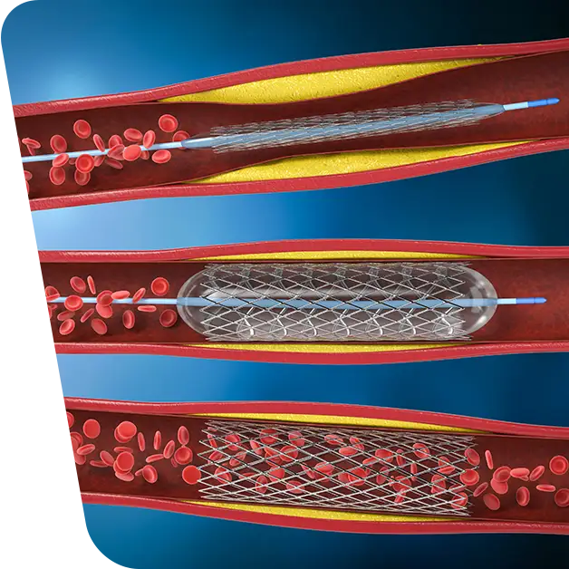 What are venous stents and what is their role