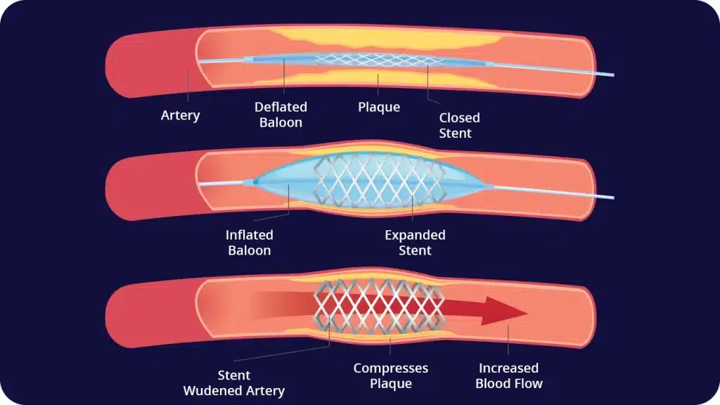 Ballon Angioplasty and Stents