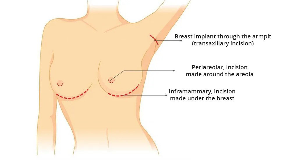 Type of scars with breast augmentation-with modern breast-implants