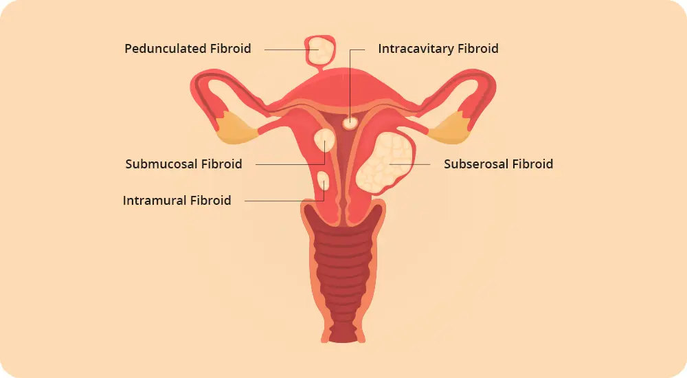 It is important to know that in most cases uterine fibroids, especially relatively small ones, go unnoticed and without any symptoms.