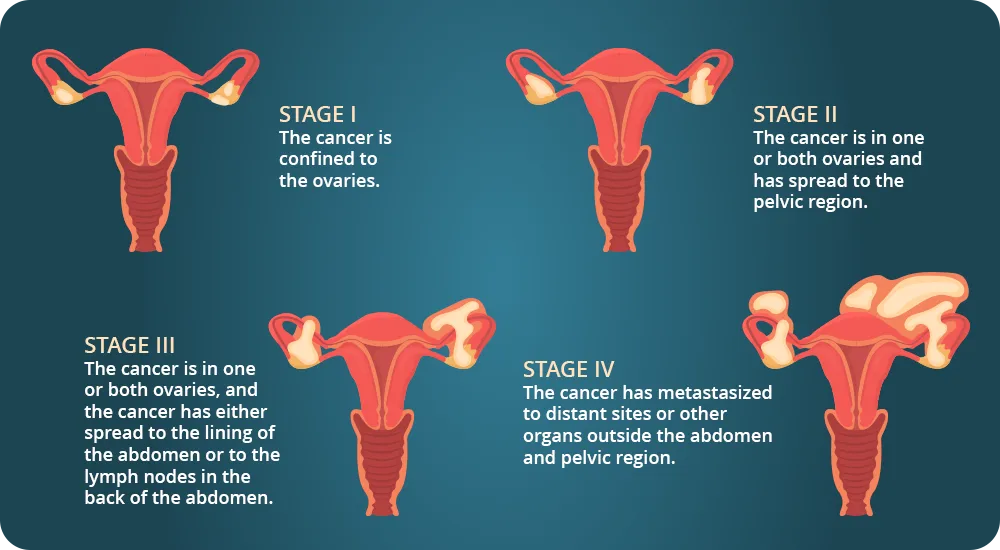 Woman reproductive system - illustration of ovarian cancer - four stages mentioning ovaries - pelvic region - lining of abdomen and metastases
