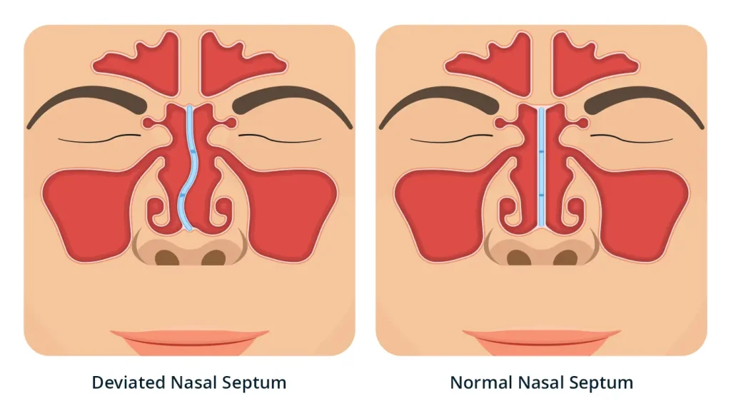 Deviated & Normal Nasal Septum