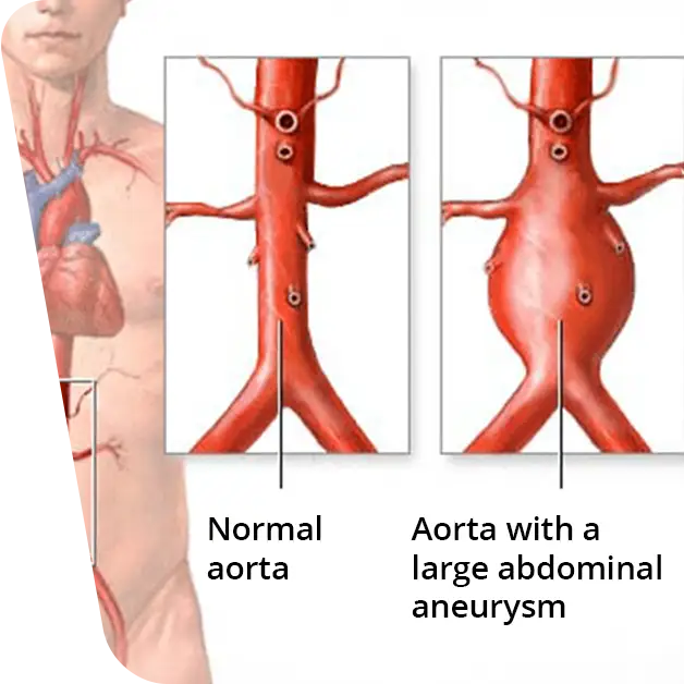 Aortic aneurysm example