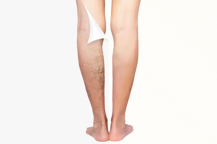 Varicose vein disease before and after image